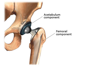 hip prothesis